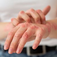 atopowe zapalenie skóry